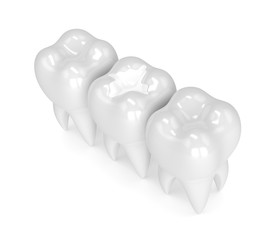 Composite Fillings