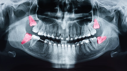 Wisdom Teeth Removal