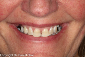 Before Implant Dentures