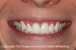 After Whitening
